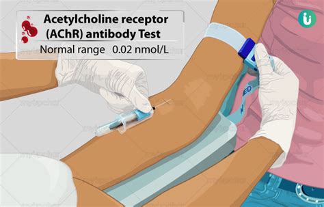 acetylcholine receptor antibody test